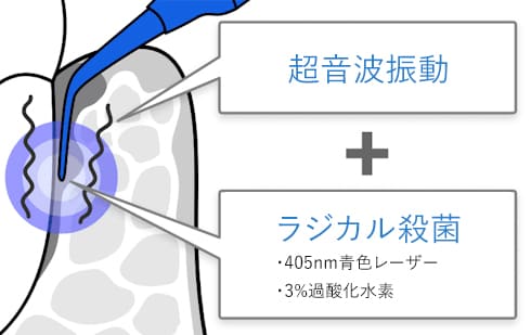 超音波振動+ラジカル殺菌